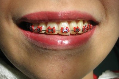 Yes. Hello Kitty braces. 