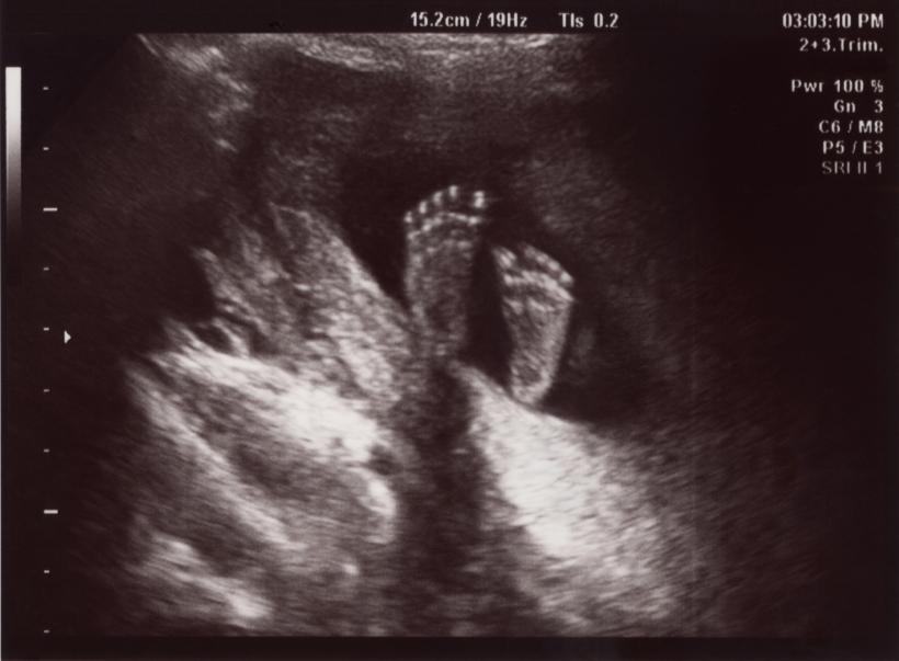 fetal feet