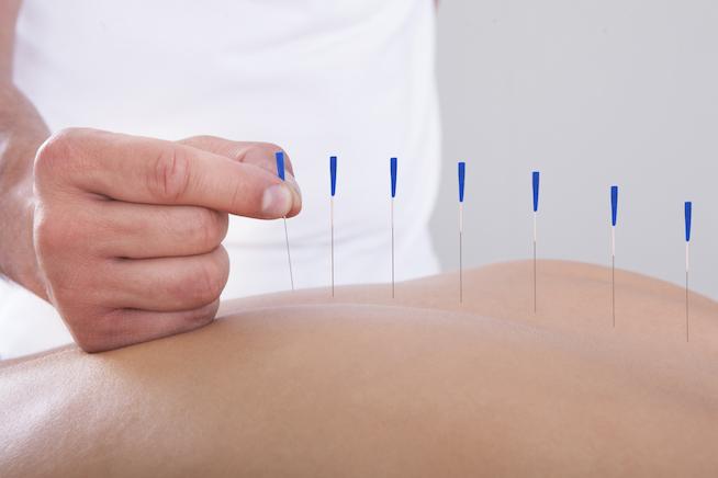 acupuncture for pain relief acupuncture for pain relief