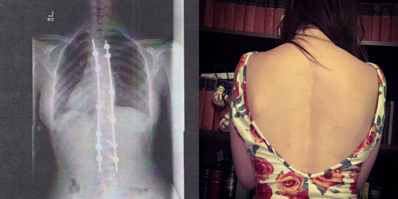 I became a bionic woman on August 24, 2009, the day after my fifteenth birthday.