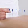acupuncture for pain relief
