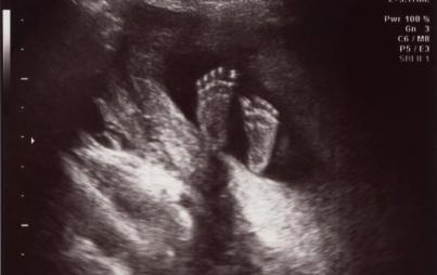 fetal feet