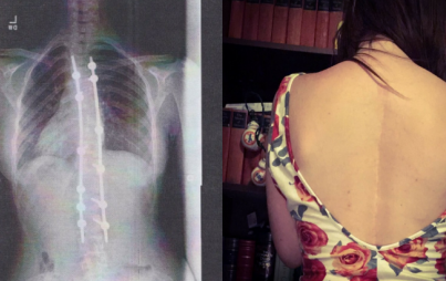 I became a bionic woman on August 24, 2009, the day after my fifteenth birthday.